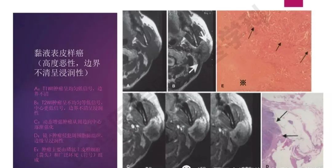 影像PPT - 【PPT】腮腺恶性肿瘤MR表现及鉴别-16