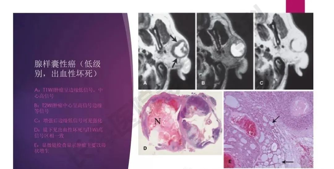 影像PPT - 【PPT】腮腺恶性肿瘤MR表现及鉴别-18