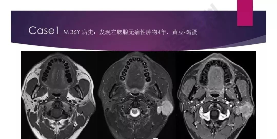 影像PPT - 【PPT】腮腺恶性肿瘤MR表现及鉴别-22