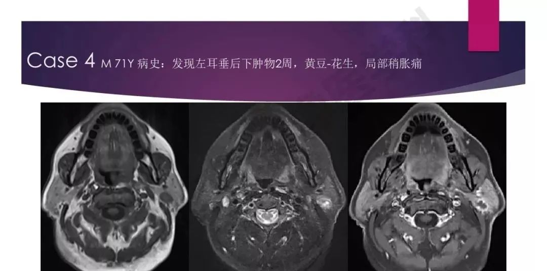 影像PPT - 【PPT】腮腺恶性肿瘤MR表现及鉴别-25