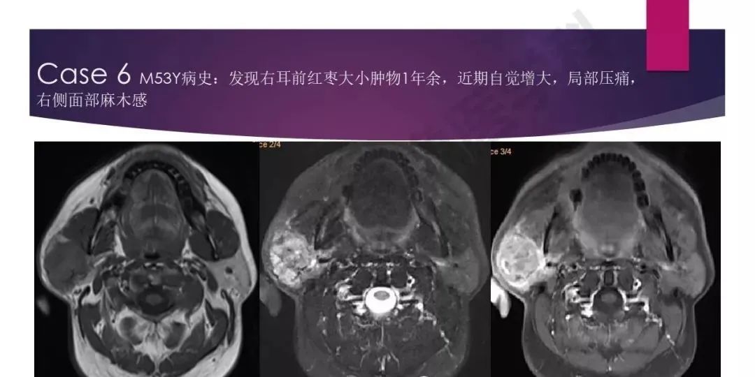 影像PPT - 【PPT】腮腺恶性肿瘤MR表现及鉴别-27