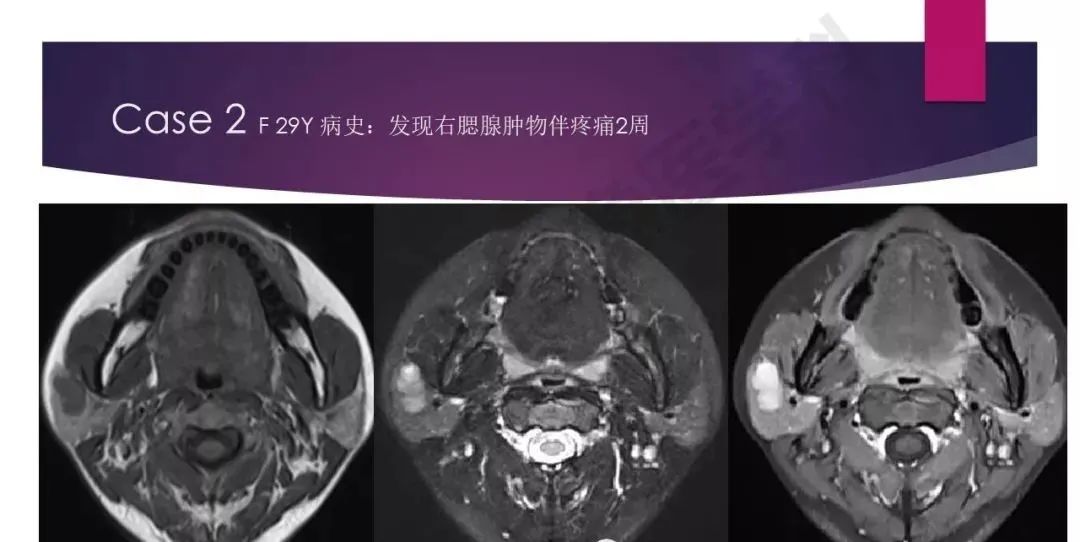 影像PPT - 【PPT】腮腺恶性肿瘤MR表现及鉴别-23