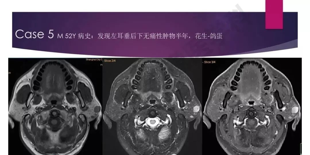 影像PPT - 【PPT】腮腺恶性肿瘤MR表现及鉴别-26