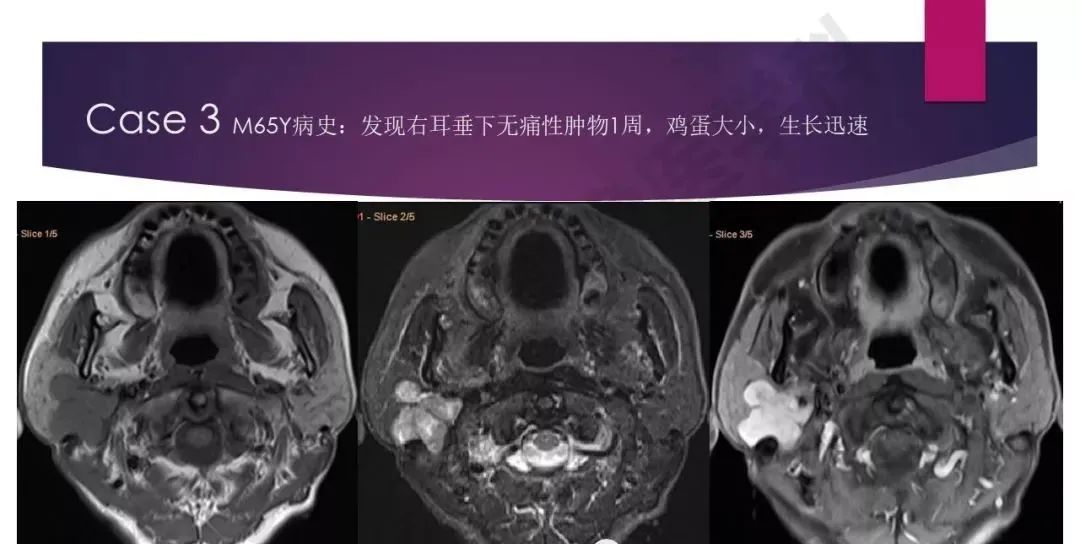 影像PPT - 【PPT】腮腺恶性肿瘤MR表现及鉴别-24