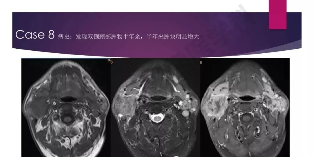 影像PPT - 【PPT】腮腺恶性肿瘤MR表现及鉴别-29