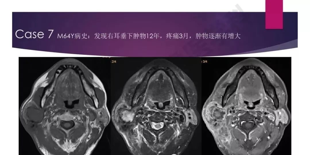 影像PPT - 【PPT】腮腺恶性肿瘤MR表现及鉴别-28