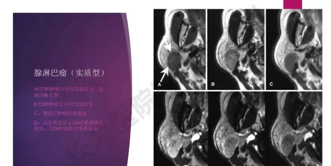 影像PPT - 【PPT】腮腺恶性肿瘤MR表现及鉴别-33