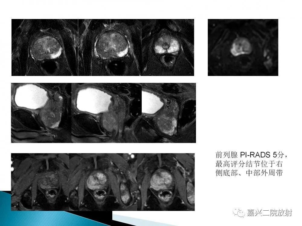 影像PPT - 【PPT】前列腺解剖分区-25
