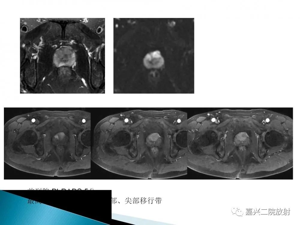 影像PPT - 【PPT】前列腺解剖分区-28