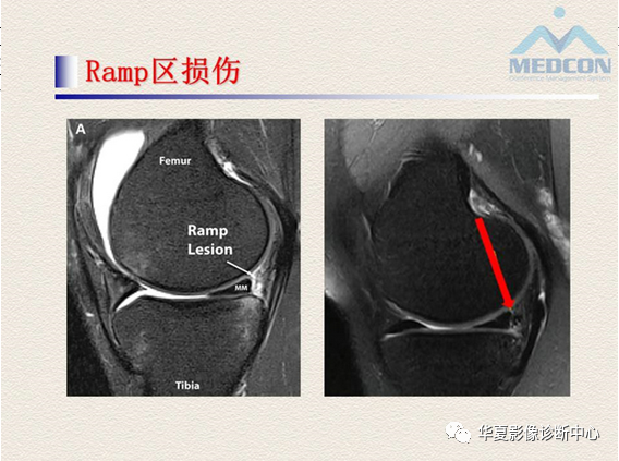 影像PPT - 【PPT】半月板的常见病变及正常变异的MRI诊断-42