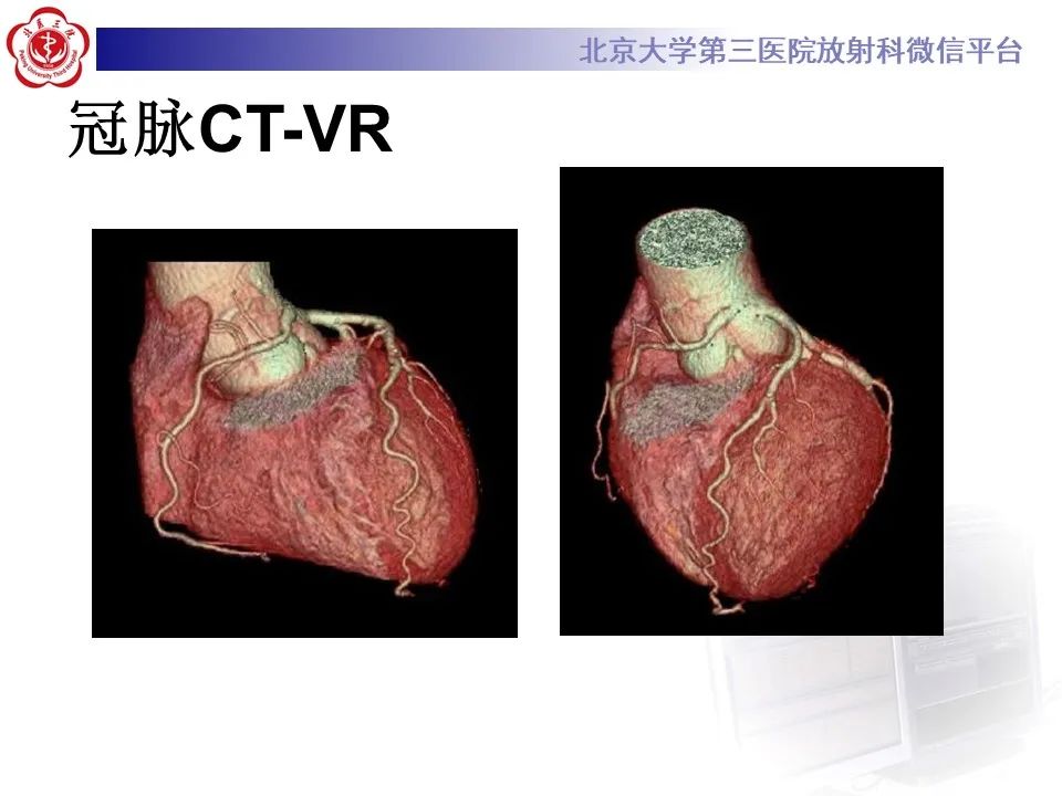 影像PPT - 【PPT】冠状动脉解剖异常-6