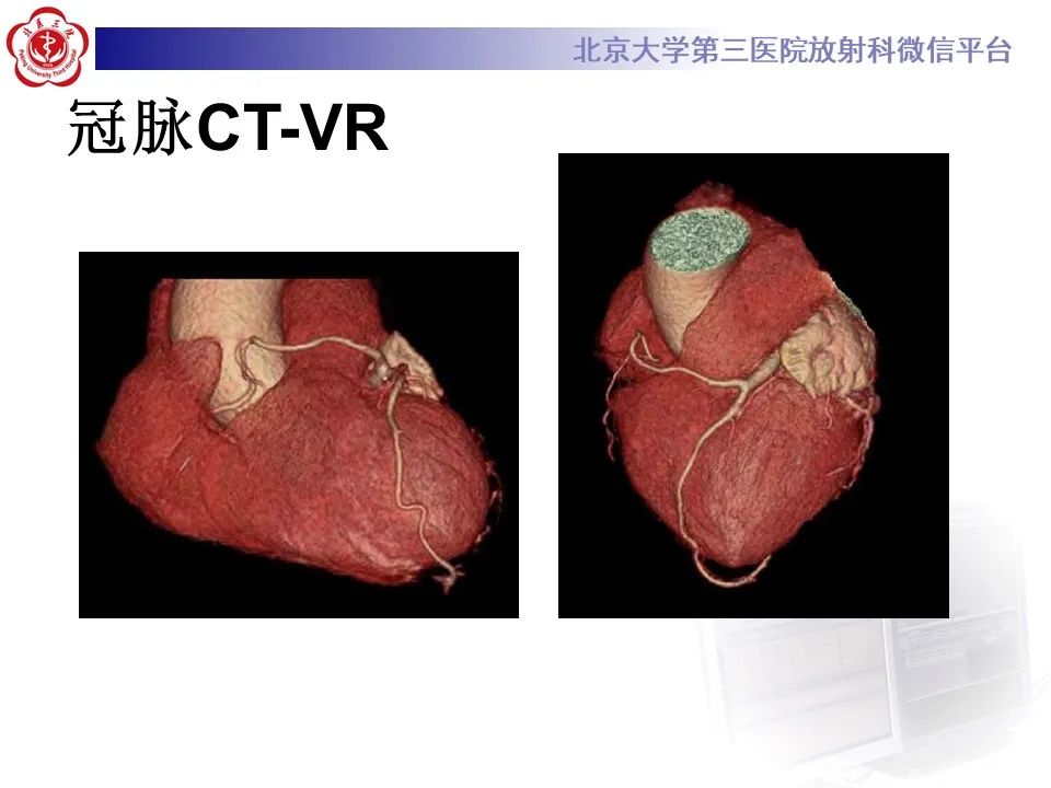 影像PPT - 【PPT】冠状动脉解剖异常-3