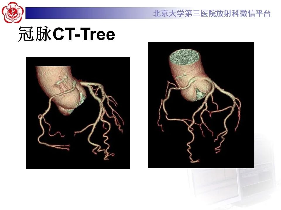 影像PPT - 【PPT】冠状动脉解剖异常-7