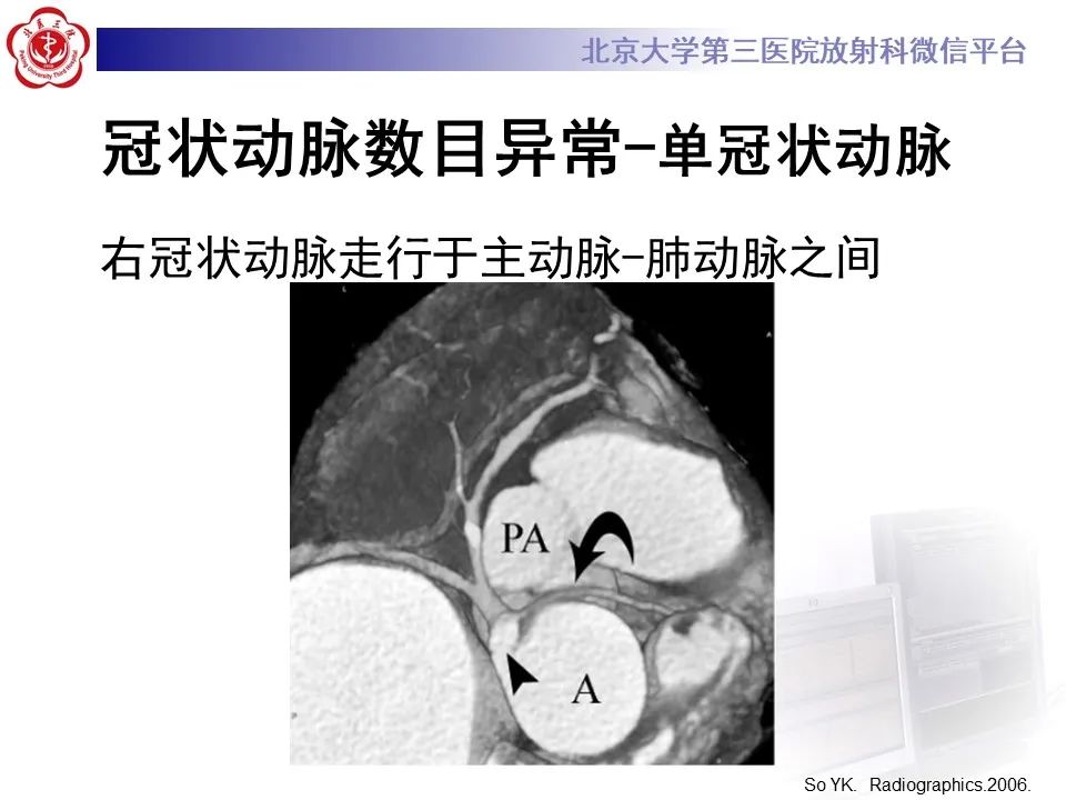 影像PPT - 【PPT】冠状动脉解剖异常-15