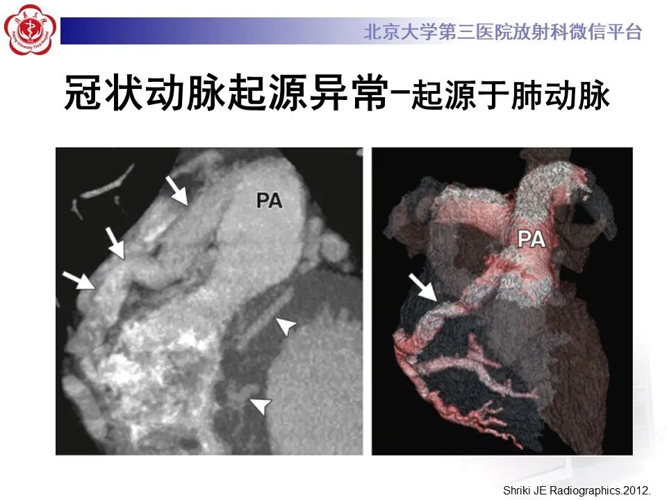 影像PPT - 【PPT】冠状动脉解剖异常-23