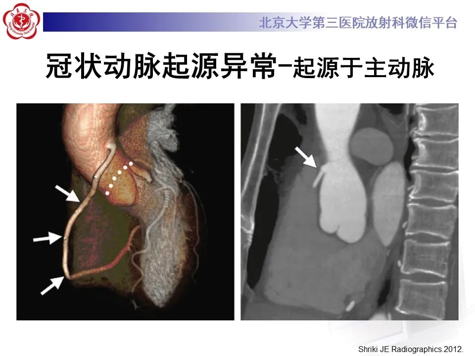 影像PPT - 【PPT】冠状动脉解剖异常-25