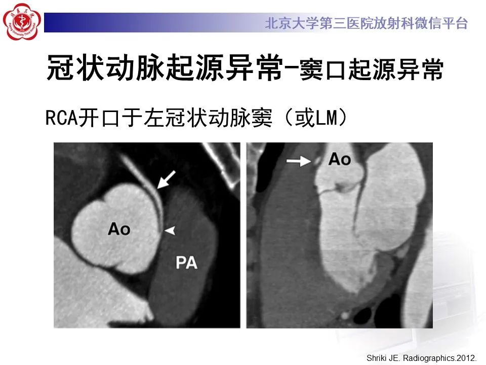 影像PPT - 【PPT】冠状动脉解剖异常-31