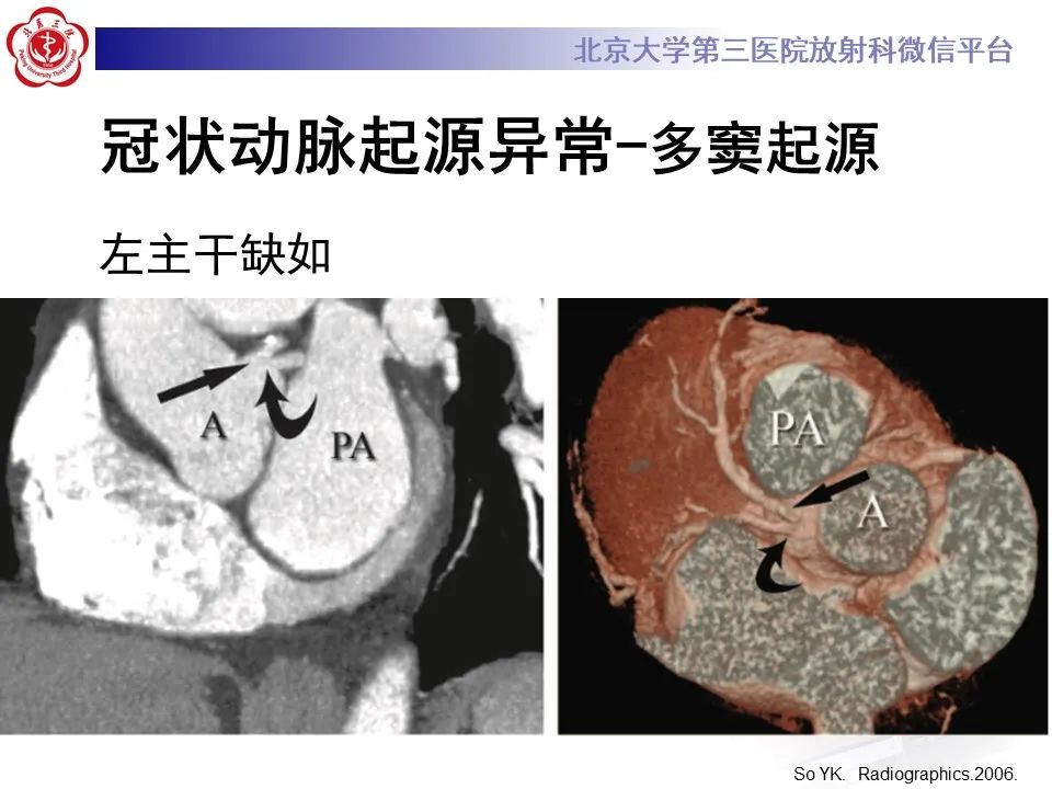 影像PPT - 【PPT】冠状动脉解剖异常-34