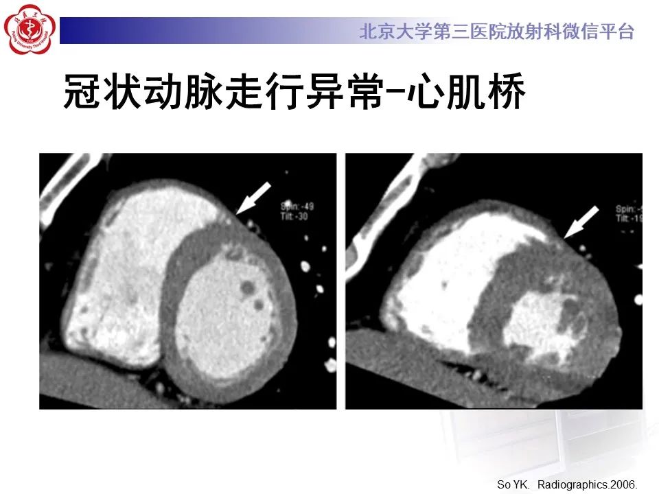 影像PPT - 【PPT】冠状动脉解剖异常-39