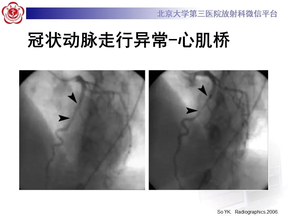 影像PPT - 【PPT】冠状动脉解剖异常-40
