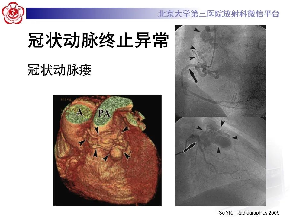 影像PPT - 【PPT】冠状动脉解剖异常-44