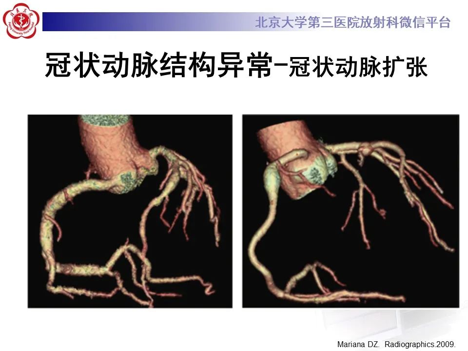 影像PPT - 【PPT】冠状动脉解剖异常-51