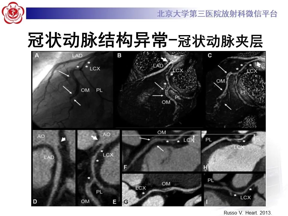 影像PPT - 【PPT】冠状动脉解剖异常-53