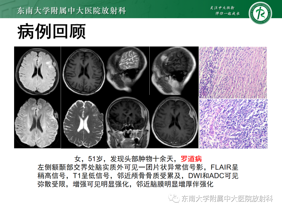 影像PPT - 【PPT】中枢神经系统罗道病-3 影像PPT - 【PPT】中枢神经系统罗道病-3