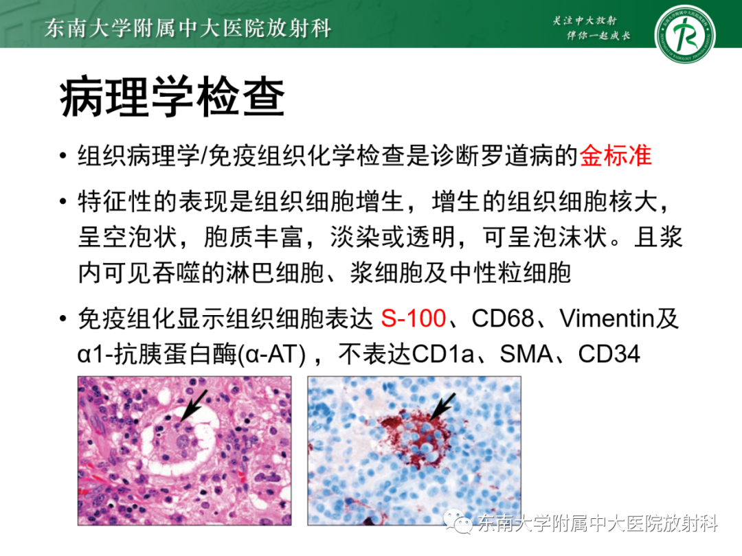 影像PPT - 【PPT】中枢神经系统罗道病-9 影像PPT - 【PPT】中枢神经系统罗道病-9