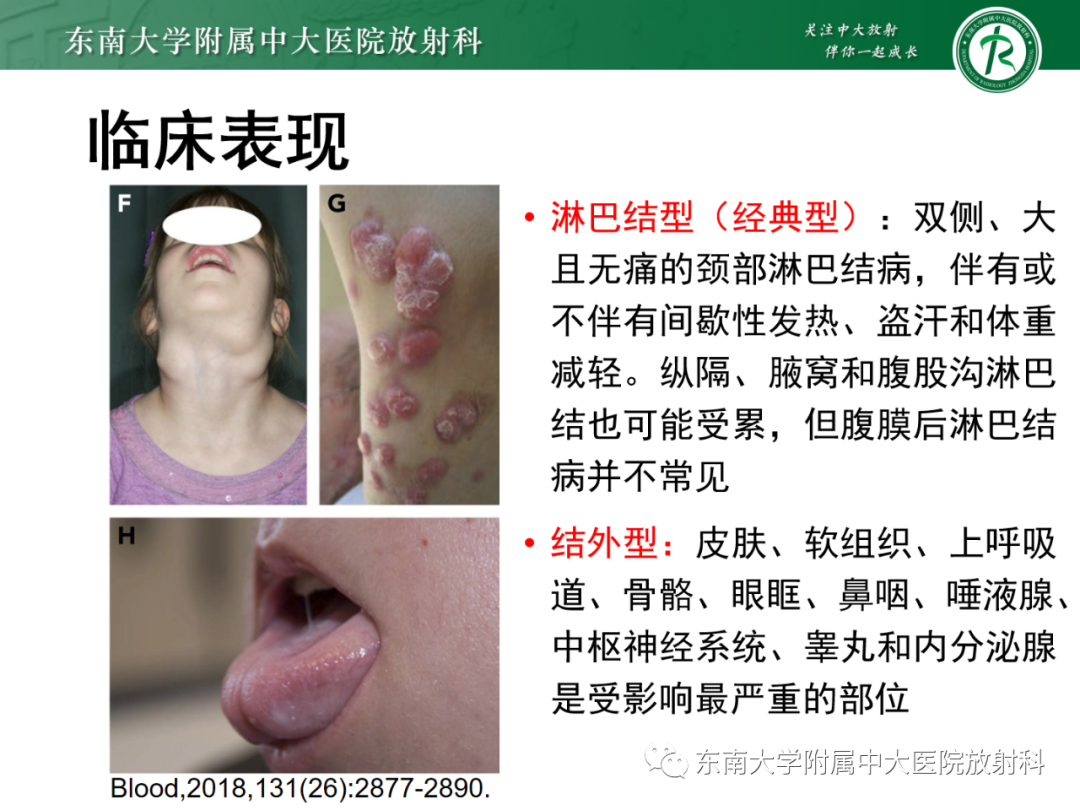 影像PPT - 【PPT】中枢神经系统罗道病-11 影像PPT - 【PPT】中枢神经系统罗道病-11