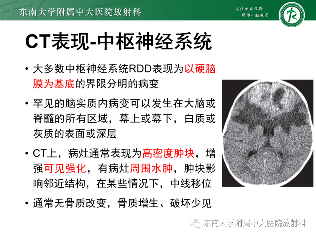 影像PPT - 【PPT】中枢神经系统罗道病-13 影像PPT - 【PPT】中枢神经系统罗道病-13