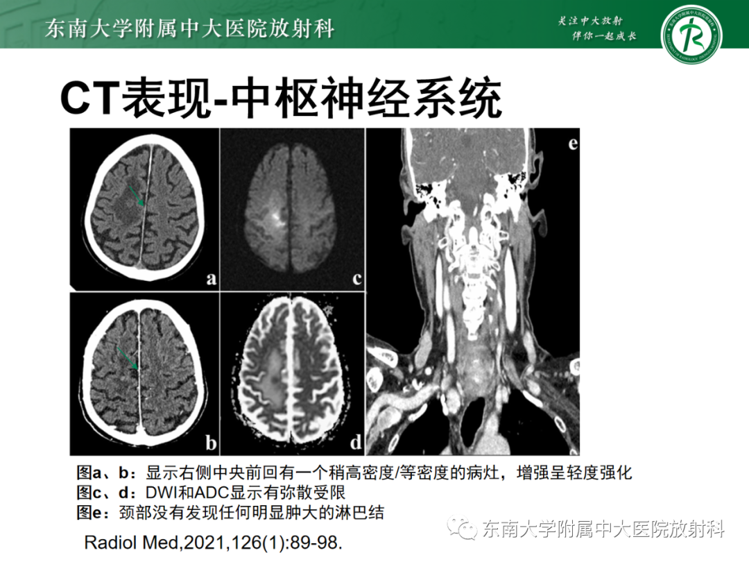 影像PPT - 【PPT】中枢神经系统罗道病-14 影像PPT - 【PPT】中枢神经系统罗道病-14