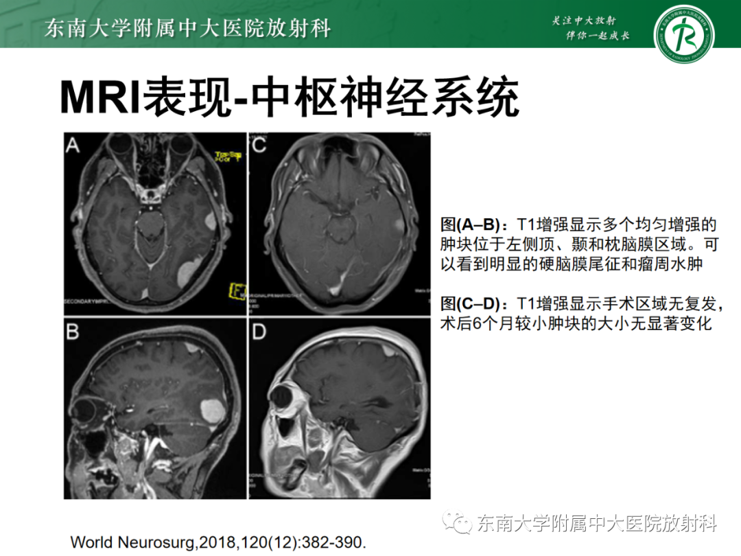 影像PPT - 【PPT】中枢神经系统罗道病-16 影像PPT - 【PPT】中枢神经系统罗道病-16