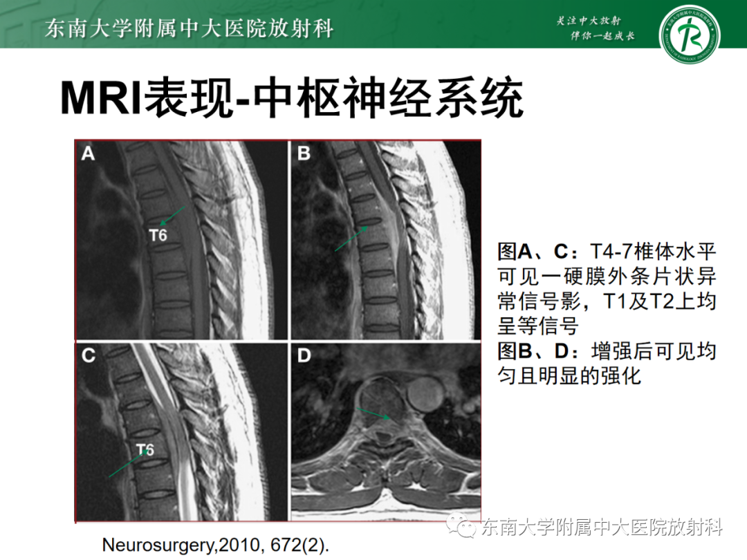 影像PPT - 【PPT】中枢神经系统罗道病-19 影像PPT - 【PPT】中枢神经系统罗道病-19