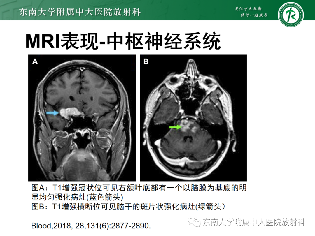 影像PPT - 【PPT】中枢神经系统罗道病-18 影像PPT - 【PPT】中枢神经系统罗道病-18