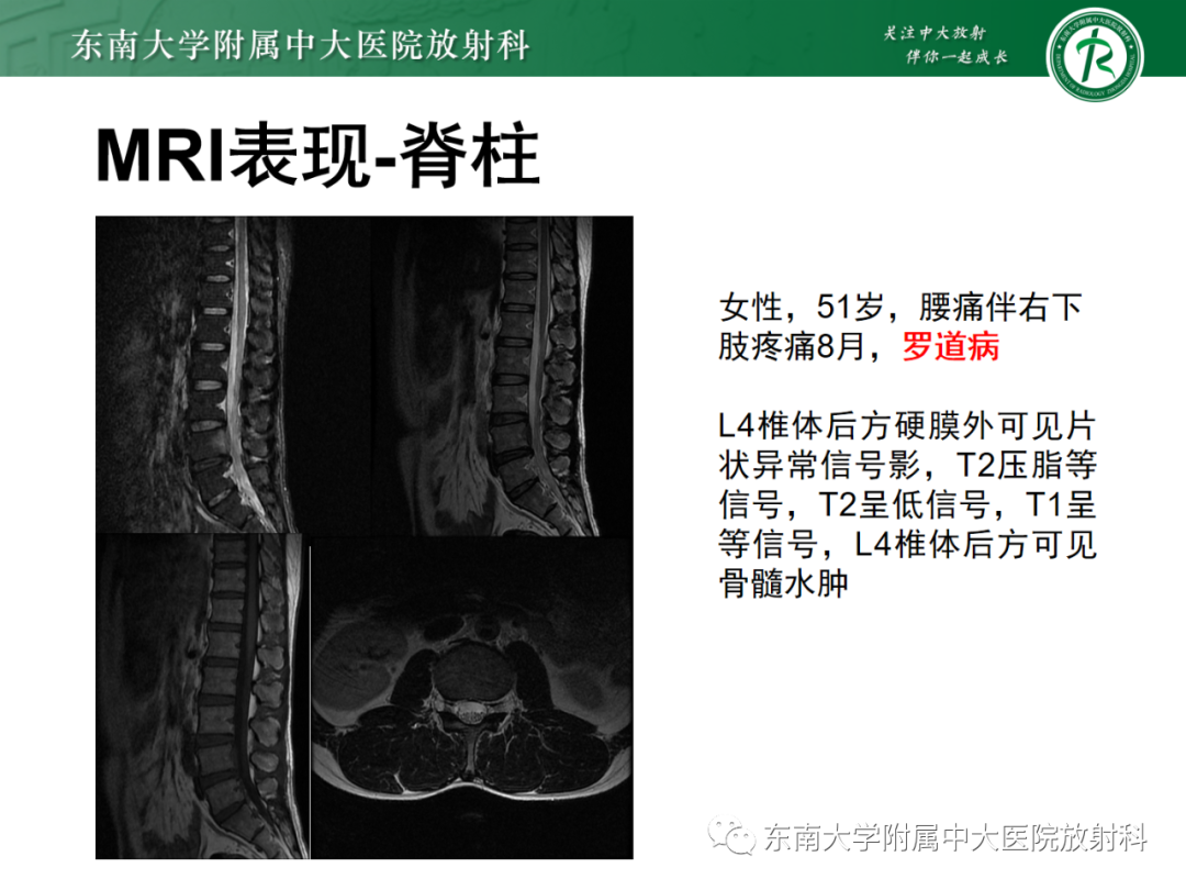 影像PPT - 【PPT】中枢神经系统罗道病-20 影像PPT - 【PPT】中枢神经系统罗道病-20