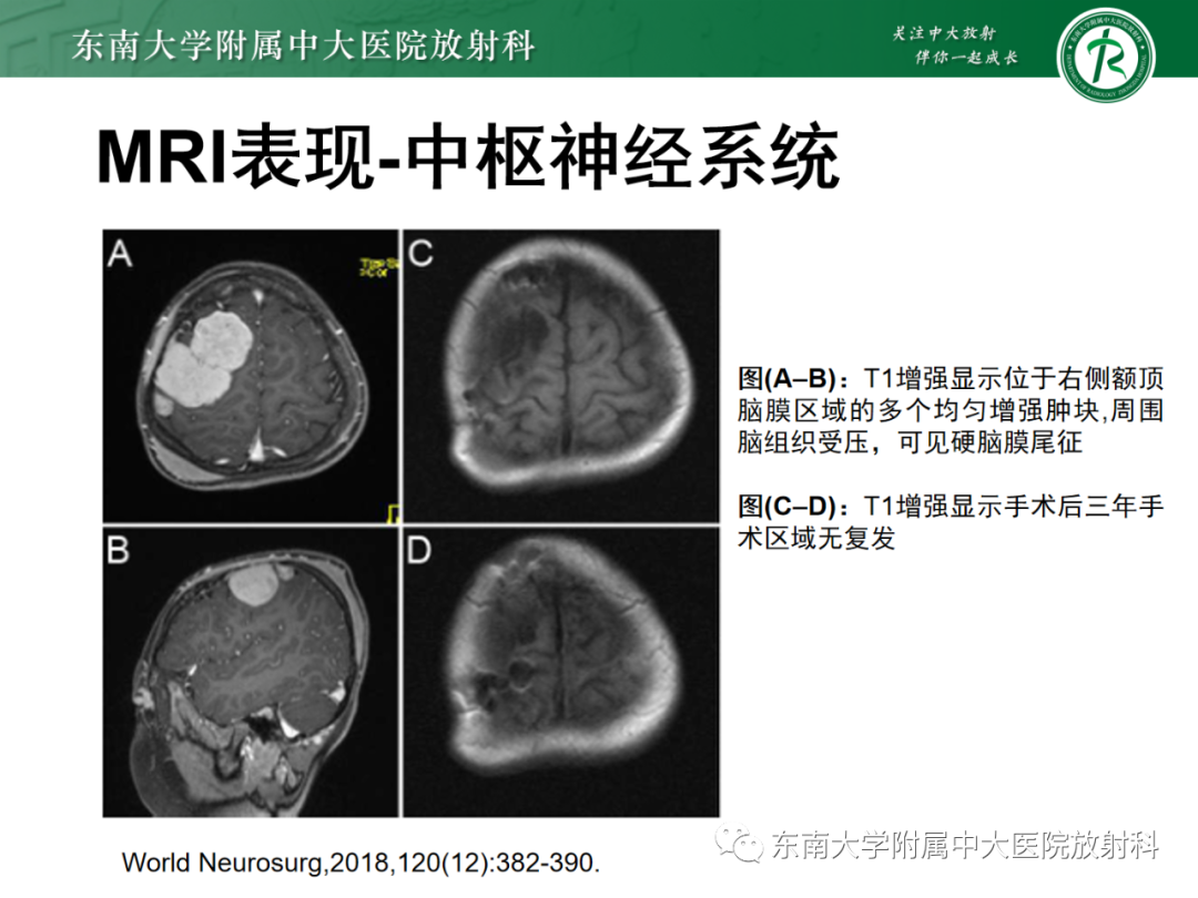 影像PPT - 【PPT】中枢神经系统罗道病-17 影像PPT - 【PPT】中枢神经系统罗道病-17