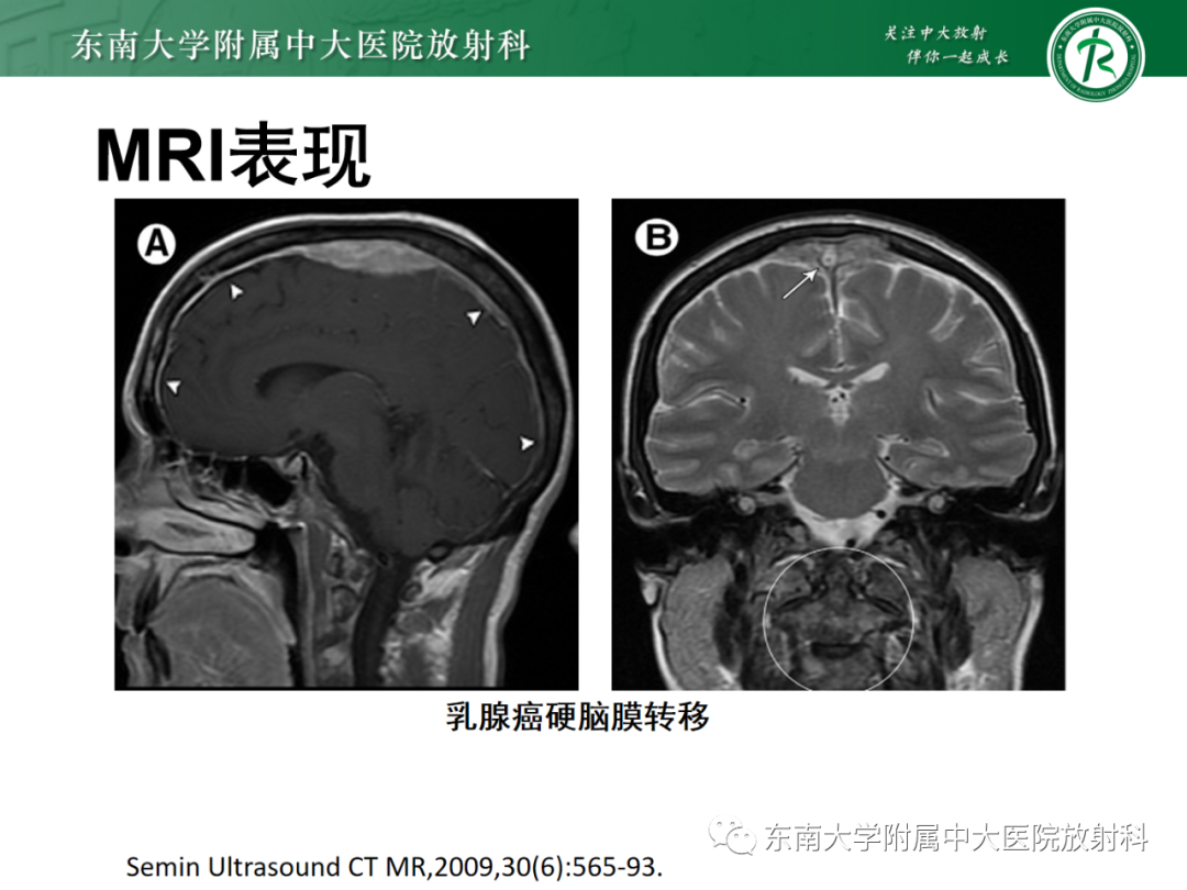 影像PPT - 【PPT】中枢神经系统罗道病-25 影像PPT - 【PPT】中枢神经系统罗道病-25