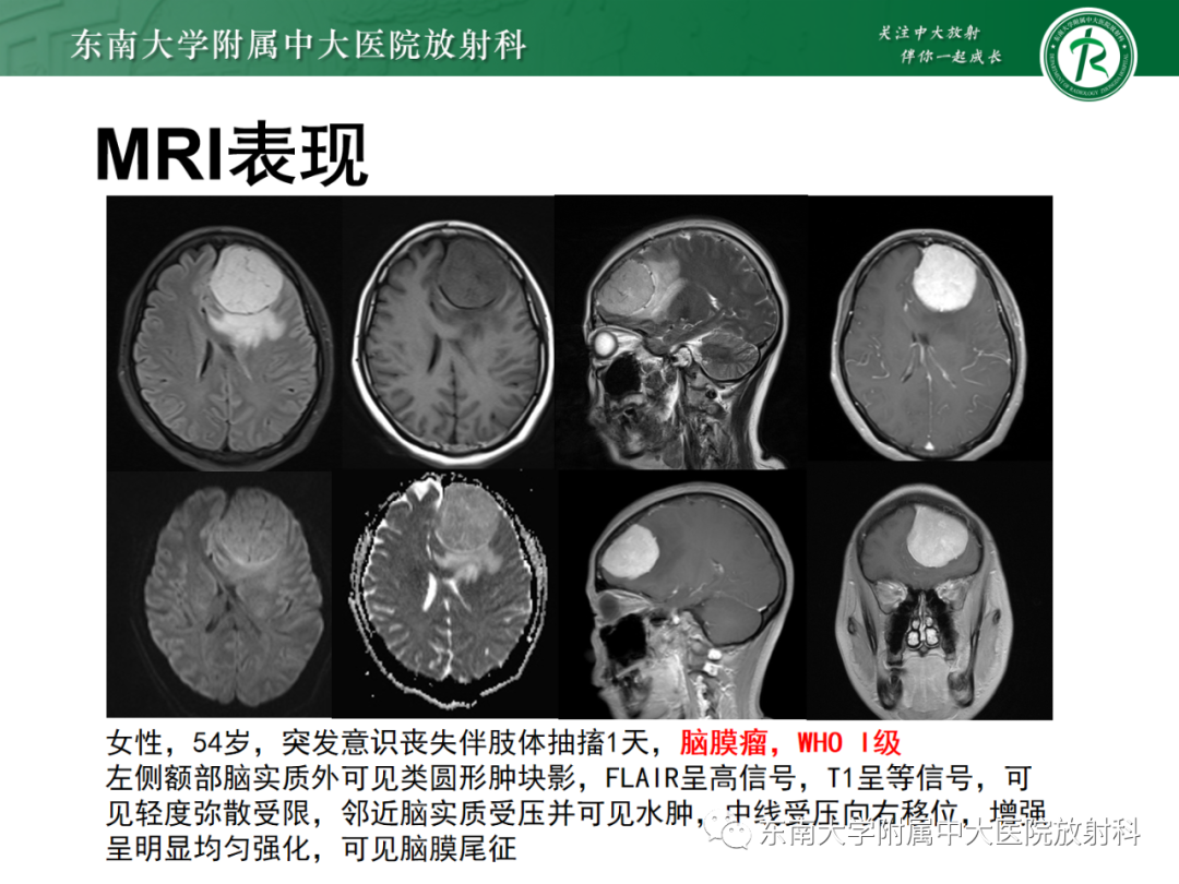 影像PPT - 【PPT】中枢神经系统罗道病-23 影像PPT - 【PPT】中枢神经系统罗道病-23