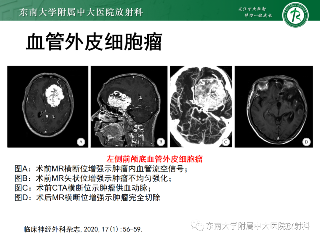 影像PPT - 【PPT】中枢神经系统罗道病-27 影像PPT - 【PPT】中枢神经系统罗道病-27