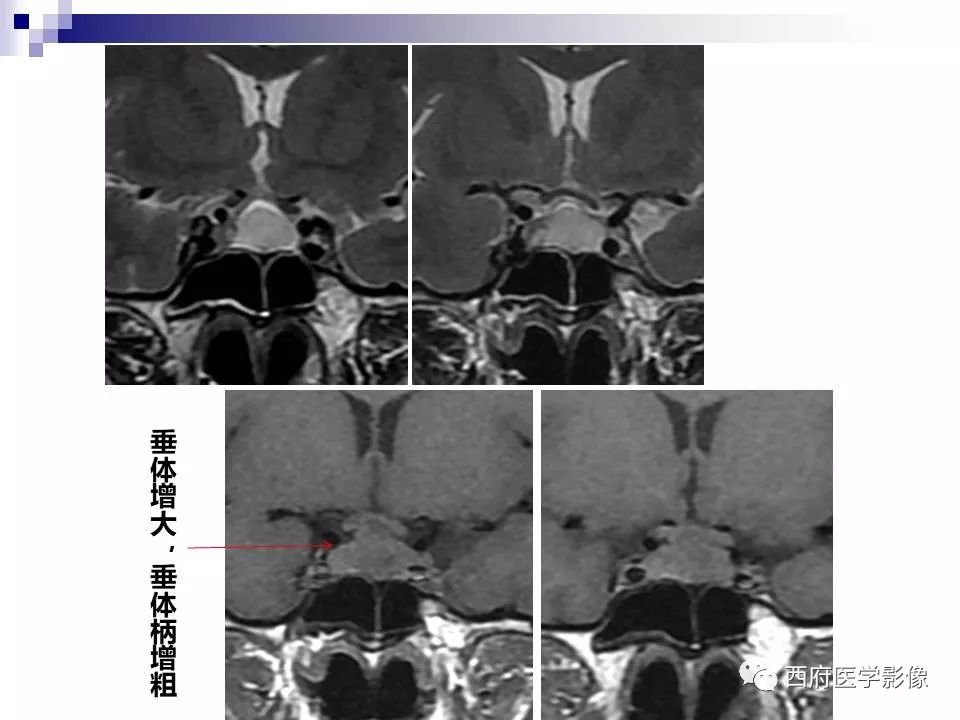 影像PPT - 【PPT】垂体囊性病变回顾性讨论-3