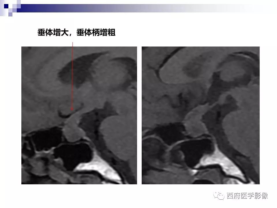 影像PPT - 【PPT】垂体囊性病变回顾性讨论-4