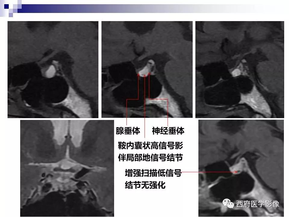 影像PPT - 【PPT】垂体囊性病变回顾性讨论-8