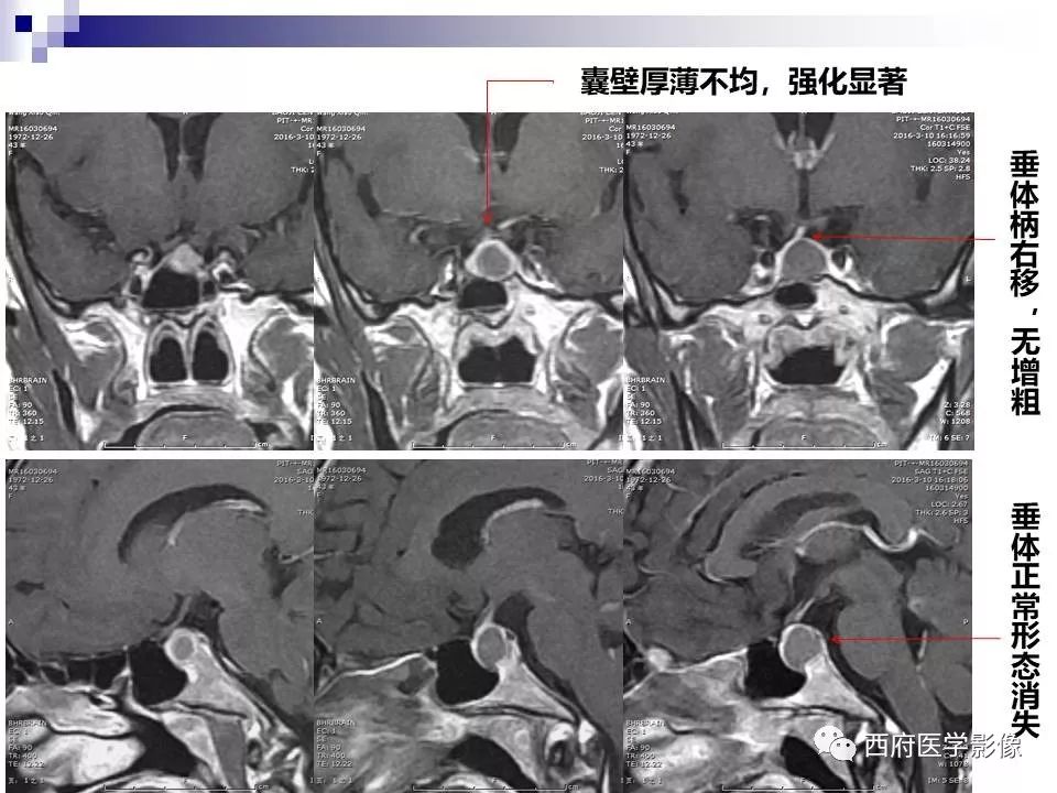 影像PPT - 【PPT】垂体囊性病变回顾性讨论-12