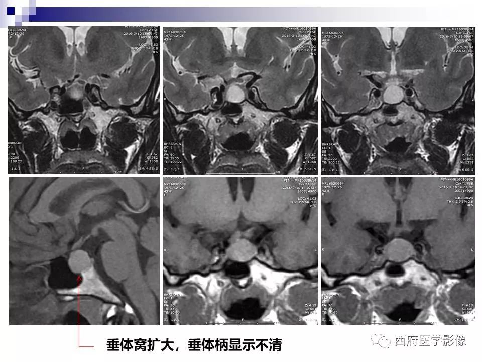 影像PPT - 【PPT】垂体囊性病变回顾性讨论-11