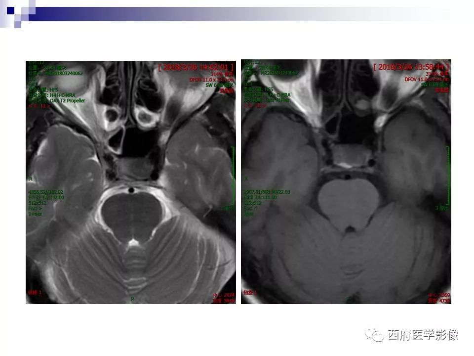 影像PPT - 【PPT】垂体囊性病变回顾性讨论-16