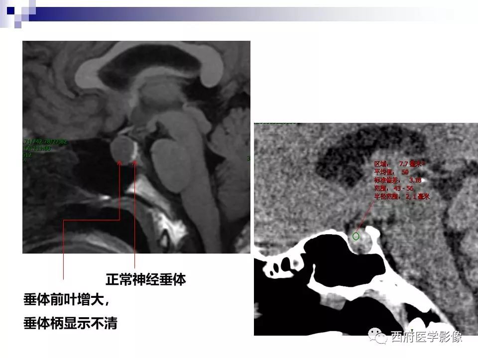 影像PPT - 【PPT】垂体囊性病变回顾性讨论-15