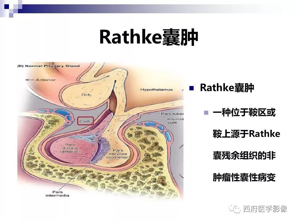影像PPT - 【PPT】垂体囊性病变回顾性讨论-24