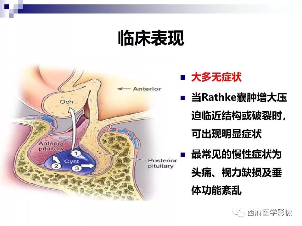 影像PPT - 【PPT】垂体囊性病变回顾性讨论-26