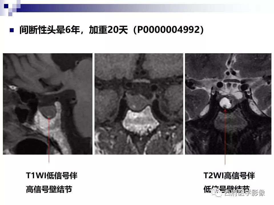 影像PPT - 【PPT】垂体囊性病变回顾性讨论-29